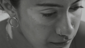 Growing Up With Vitiligo, I Was Bullied—Until I Became A Bully