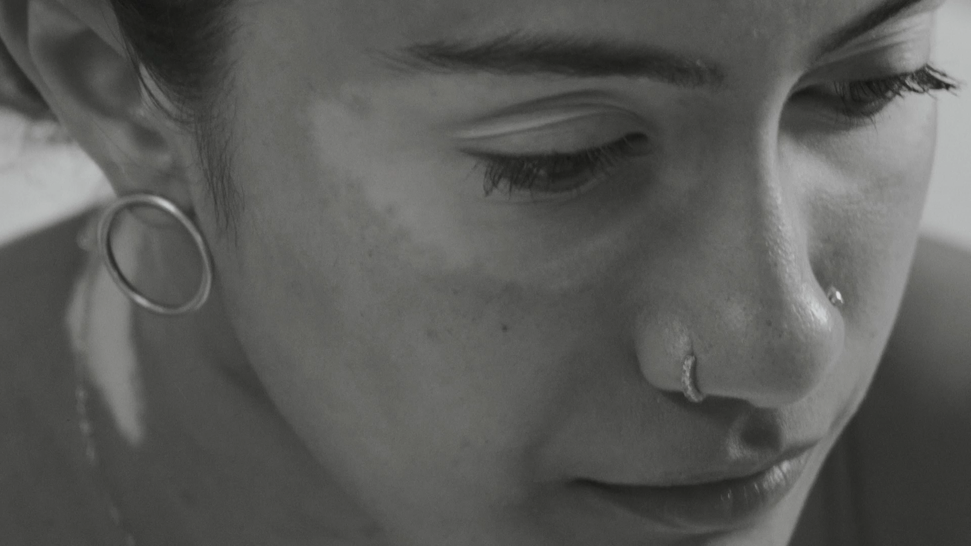 Growing Up With Vitiligo, I Was Bullied—Until I Became A Bully