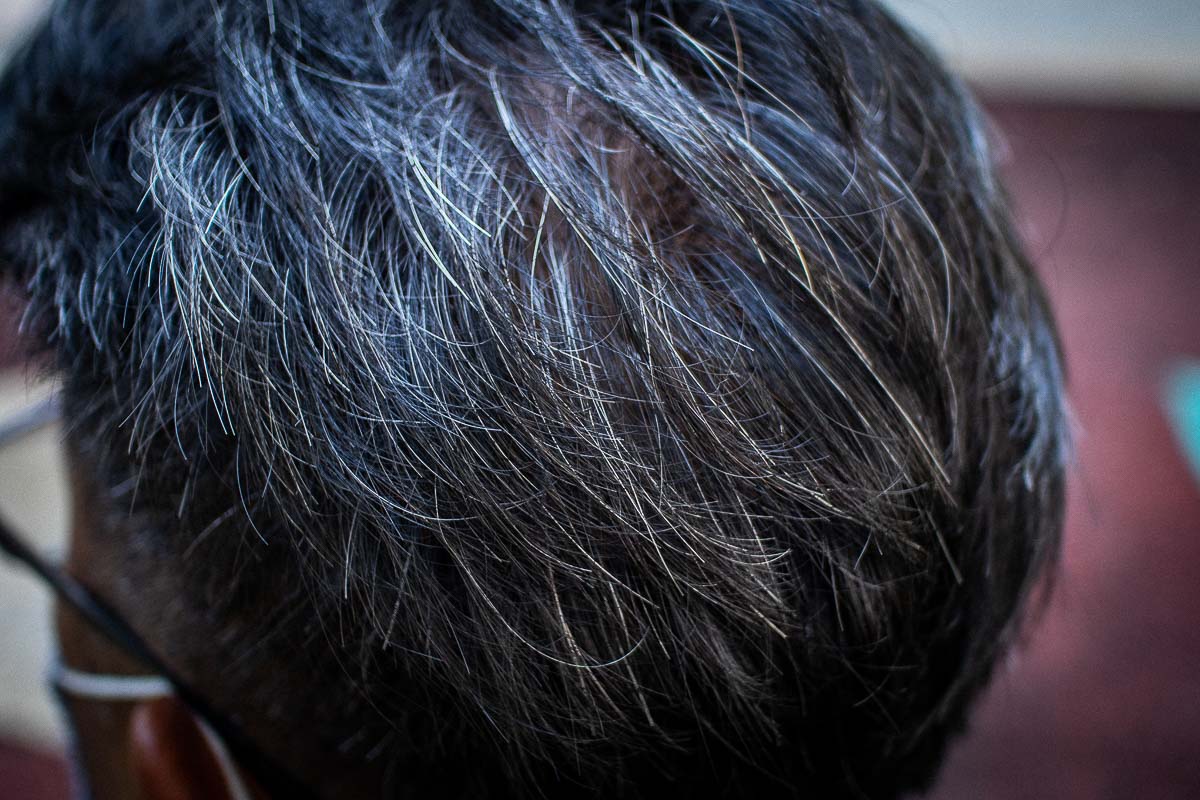 White hair: Causes and ways to prevent it